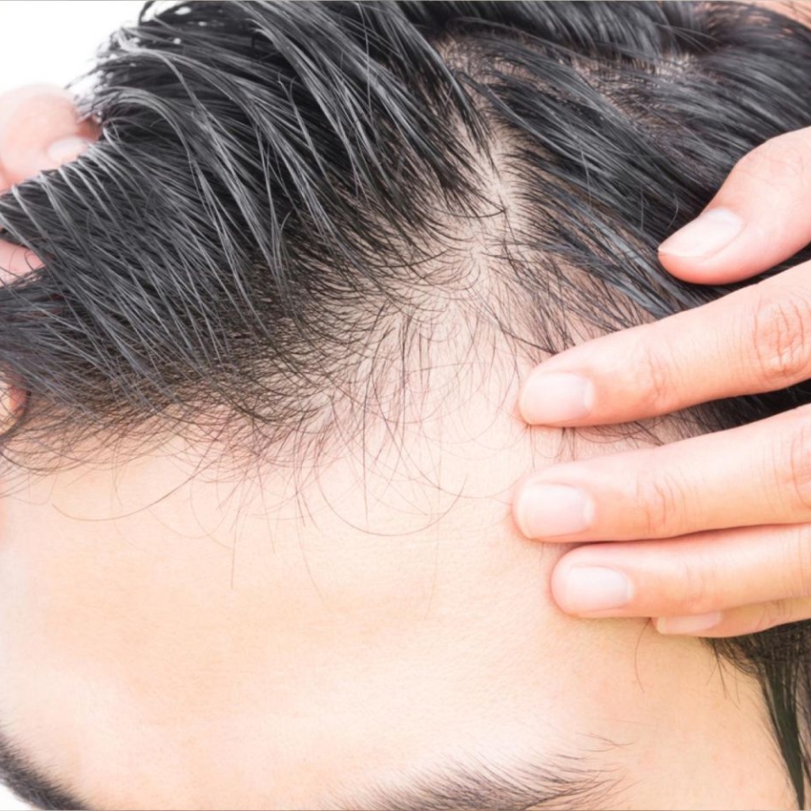 Can Topical Retinoids Cause Hair Loss  DS Healthcare Group