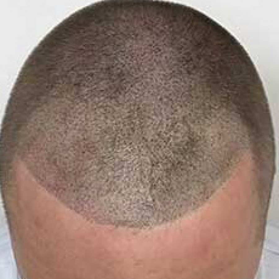 Scalp Micropigmentation (SMP)