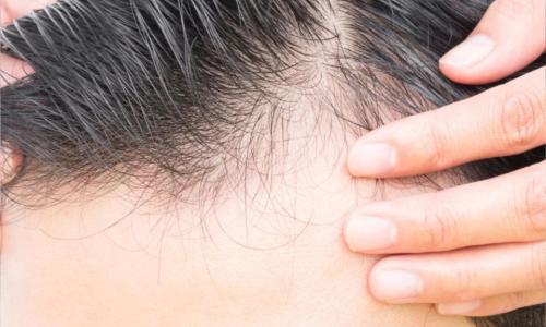 Causes of hair loss