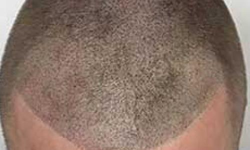 Scalp Micropigmentation (SMP)