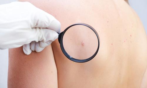 Warts & Moles